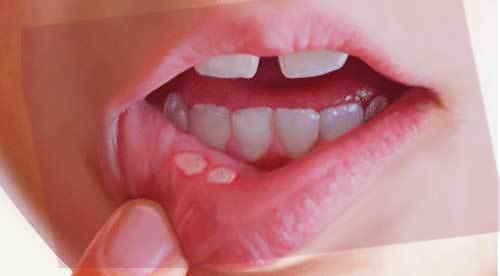 Cold sores and their occurrence