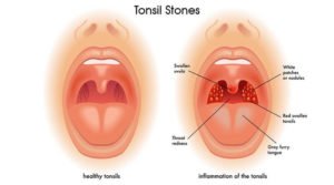 How to remove tonsil stones you can't see