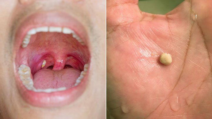 How to Remove Tonsil Stones
