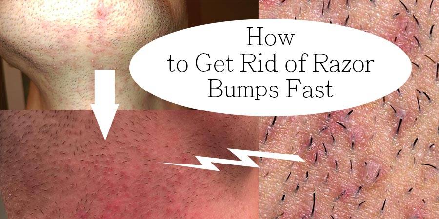 How to Get Rid Of Razor Bumps Fast?