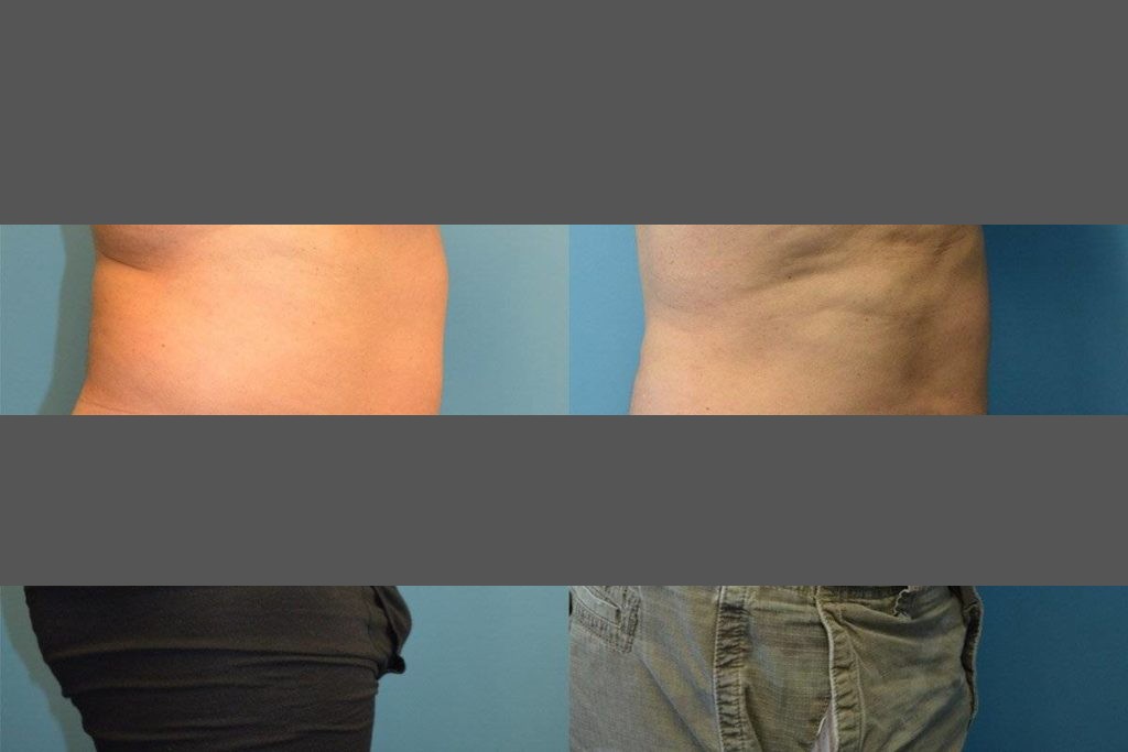 Tummy Tuck Scars After 5 Years 