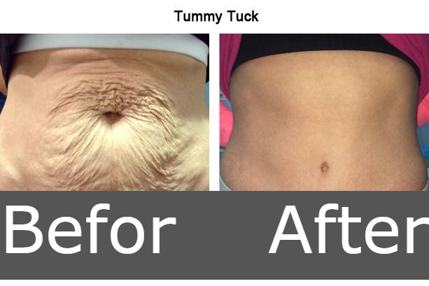 Tummy Tuck Scars After 5 Years