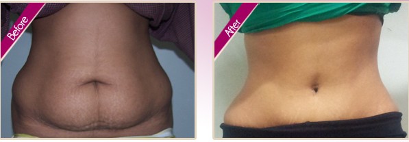 Tummy Tuck Before and After 