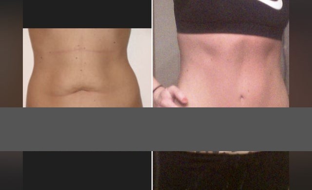 Tummy Tuck Scars After 5 Years 