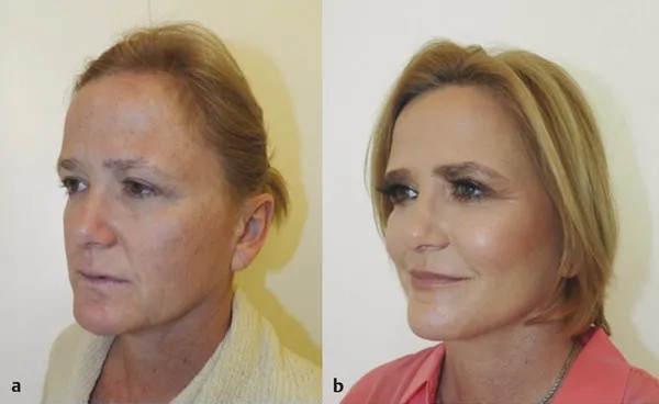Which Other Facial Rejuvenation Procedures Can Be Combined With A Mid Facelift?